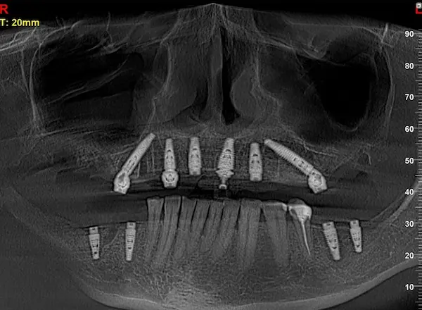 Імплантація зубів в DentalKnysh 2026-04-18 Скан КТ 7