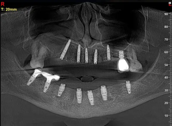 Скан КТ імплантації зубів 2026-04-18, скан 8