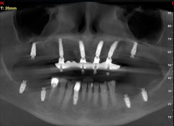 Скан КТ імплантації зубів 2026-04-18, скан 9