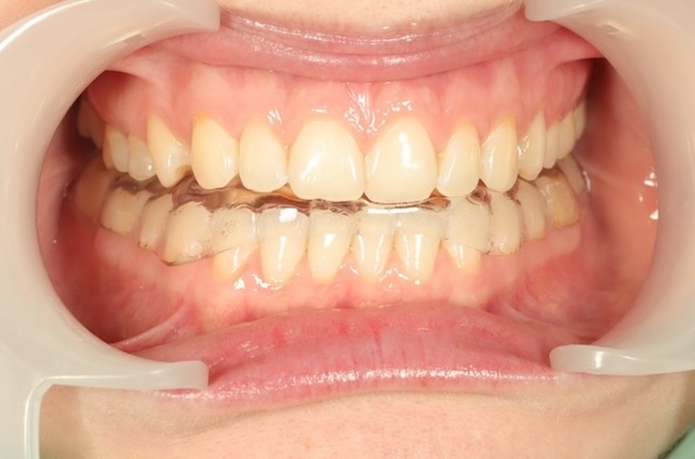 Фото отчет лечения у гнатолога в DentalKnysh, 2026-05-03, фото 2