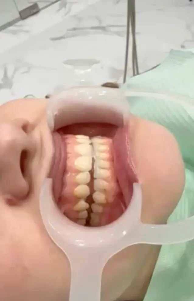 Результаты лечения СНЩС у гнатолога в DentalKnysh, видео 1, 2026-05-03