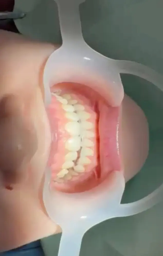 Результаты лечения височно нижнечелюстного сустава в DentalKnysh, видео 2, 2026-05-03