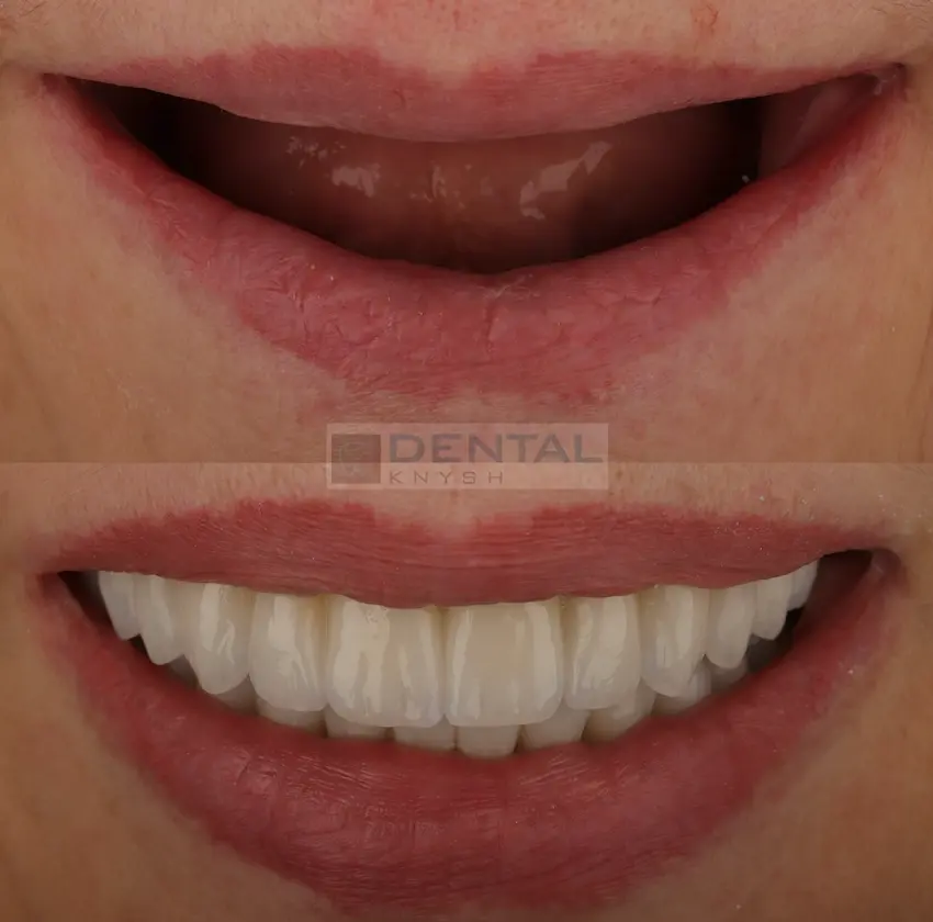 Фото звіт: тотальна імплантація зубів all-on-6, дві щелепи, DentalKnysh, фото 1, 2026-06-18