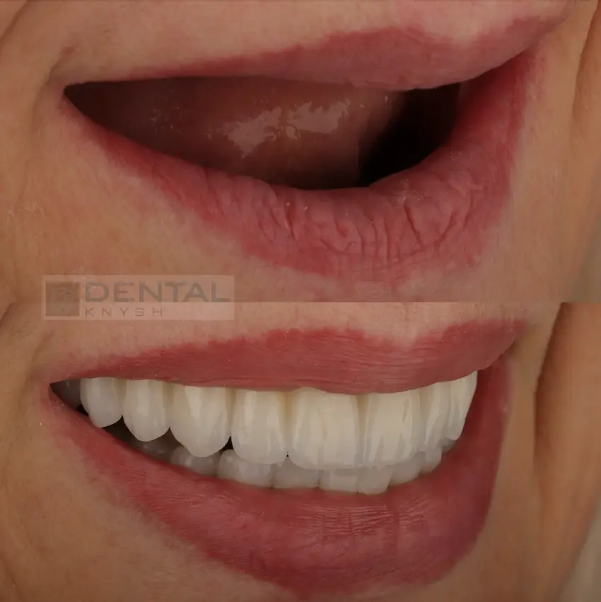 Фото звіт: тотальна імплантація зубів all-on-6, дві щелепи, DentalKnysh, фото 2, 2026-06-18