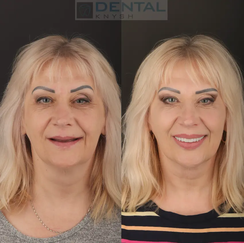 Фото звіт: тотальна імплантація зубів all-on-6, дві щелепи, DentalKnysh, фото до/після, 2026-06-18