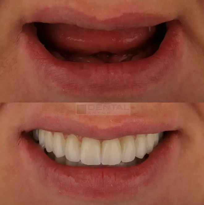 Фото звіт: імплантація зубів в DentalKnysh дві щелепи 2026-06-11, фото 1