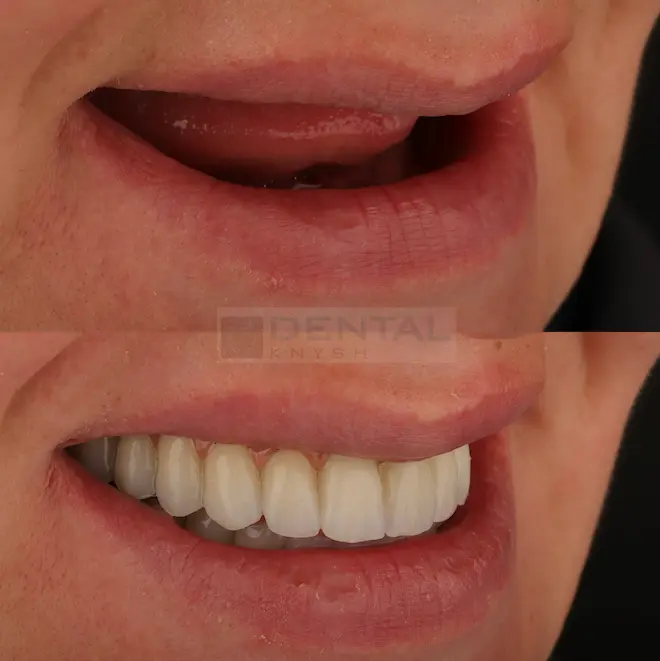 Фото звіт: імплантація зубів в DentalKnysh дві щелепи 2026-06-11, фото 2