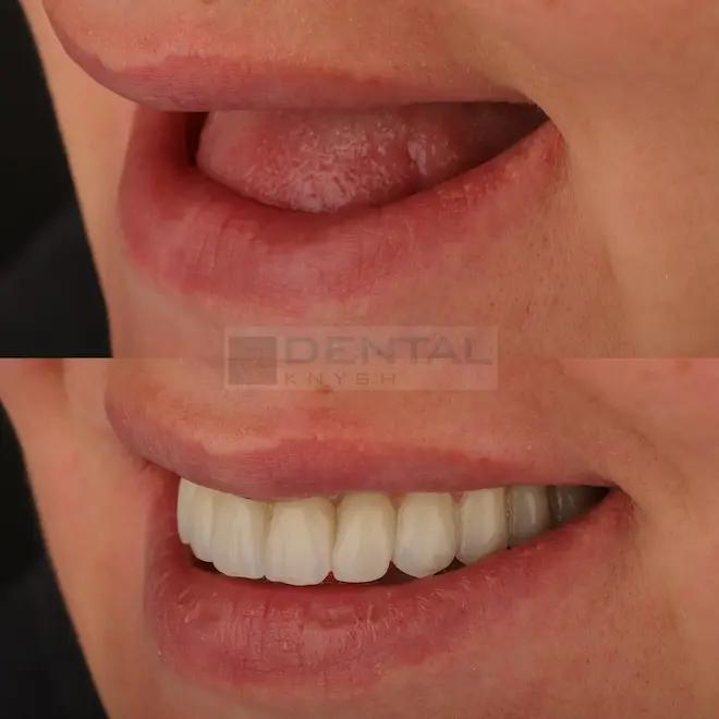 Фото звіт: імплантація зубів в DentalKnysh дві щелепи 2026-06-11, фото 3