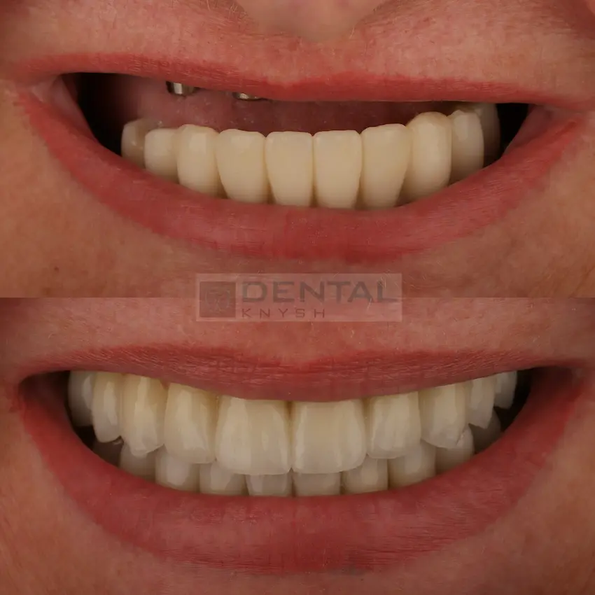 Photo report: all-on-6 dental implantation, DentalKnysh, 2026-07-05
