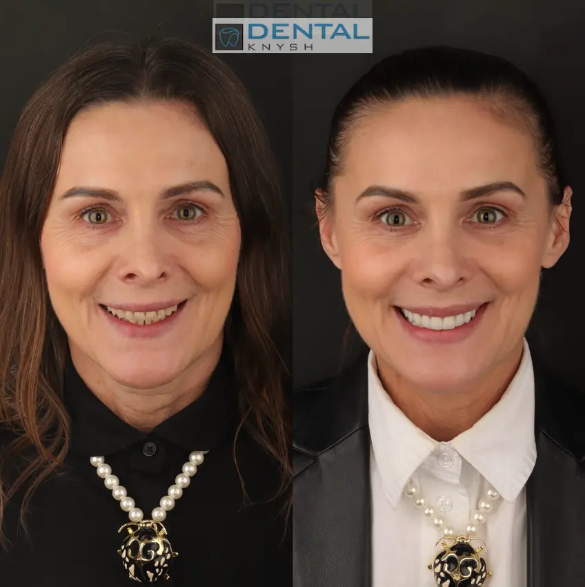 Photo report: results of ceramic veneers installation in DentalKnysh, 2026-07-17