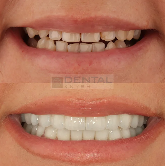 Фото-отчет: результаты установки керамических виниров в DentalKnysh, 2026-07-28, фото 1
