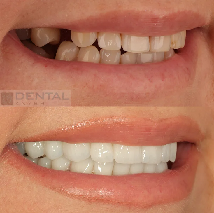 Фото-отчет: результаты установки керамических виниров в DentalKnysh, 2026-07-28, фото 2