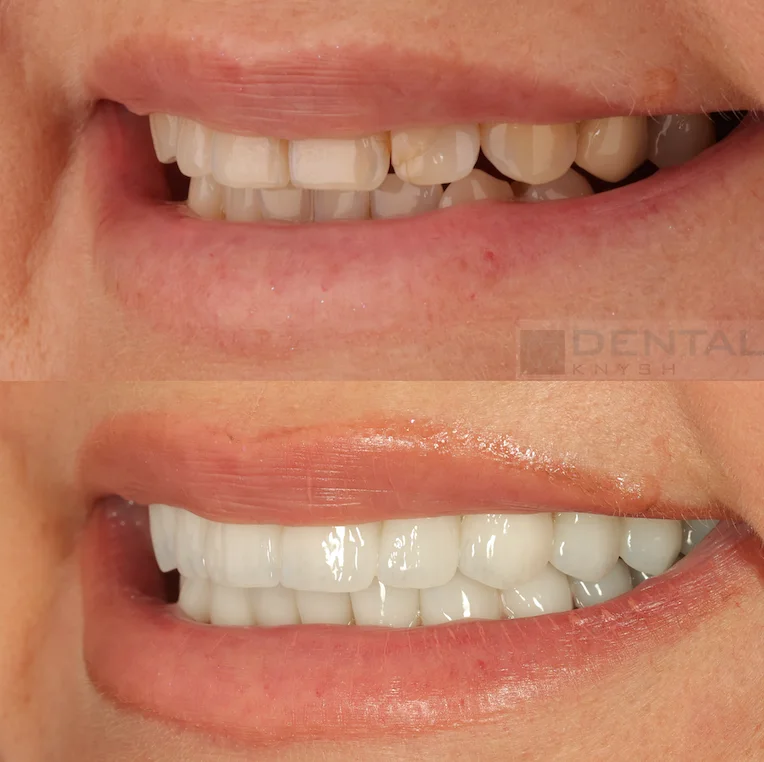 Фото-отчет: результаты установки керамических виниров в DentalKnysh, 2026-07-28, фото 3