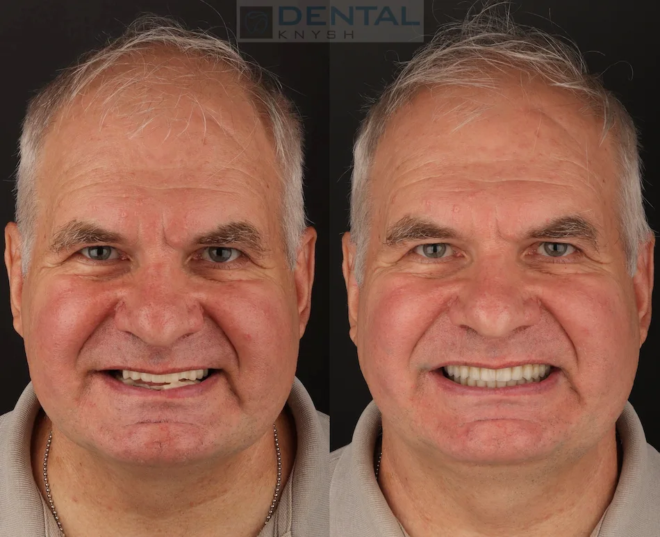 Фото отчет: имплантация зубов all-on-6 в DentalKnysh, фото до/после, 2026-08-02