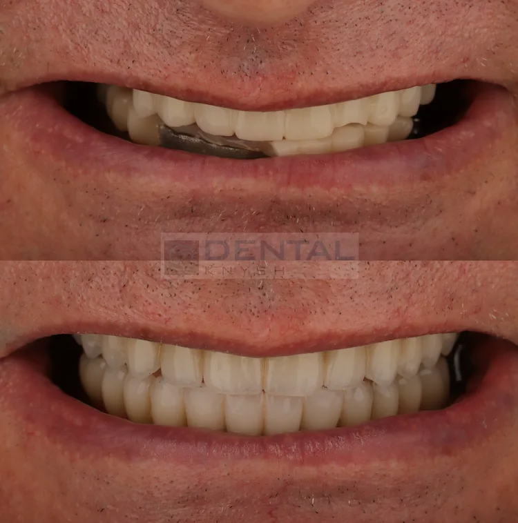 Фото отчет: имплантация зубов в DentalKnysh, 2026-08-11, фото 1