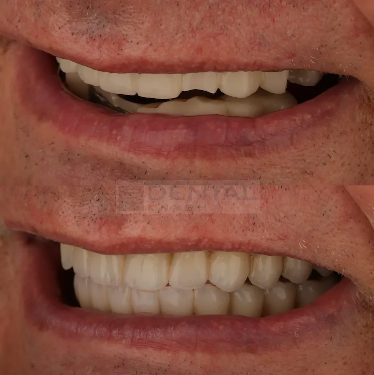 Фото отчет: имплантация зубов в DentalKnysh, 2026-08-11, фото 2
