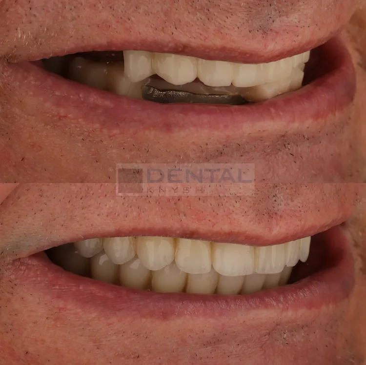 Фото отчет: имплантация зубов в DentalKnysh, 2026-08-11, фото 3