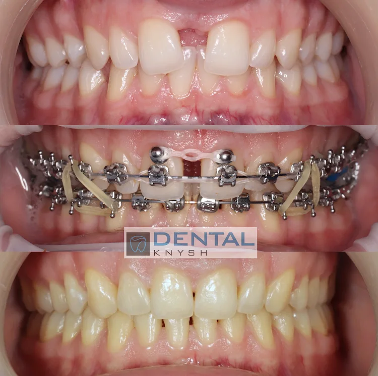Результати ортодонтичного лікування в DentalKnysh, 2026-09-11