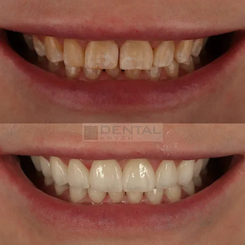 Фото отчет: результат установки керамических виниров в DentalKnysh, 2026-10-23, фото 1