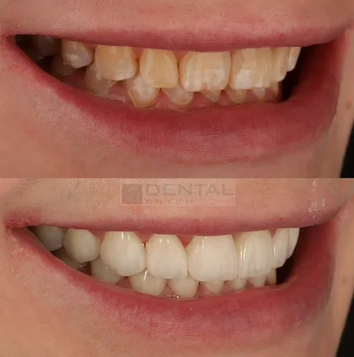 Фото отчет: результат установки керамических виниров в DentalKnysh, 2026-10-23, фото 2