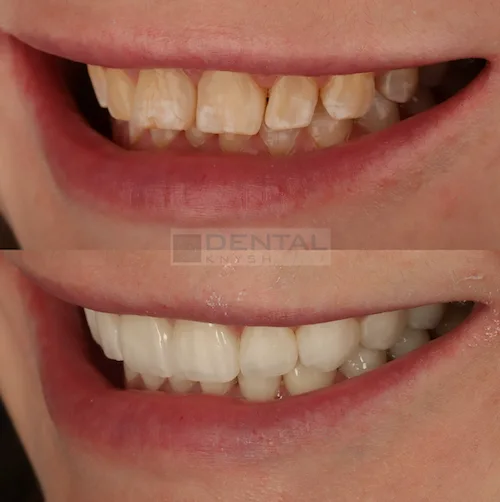 Фото отчет: результат установки керамических виниров в DentalKnysh, 2026-10-23, фото 3