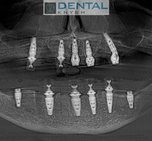 Імплантація зубів в DentalKnysh 2026-06