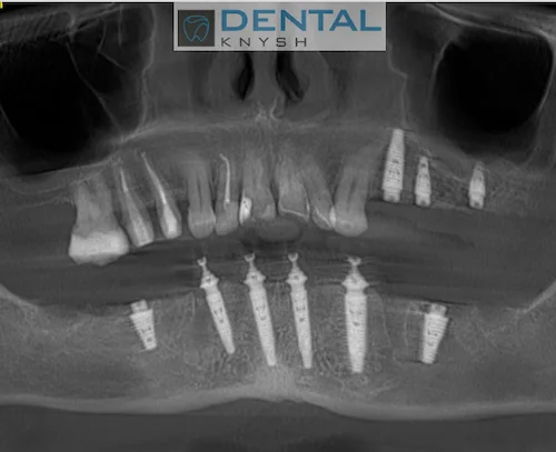 Імплантація зубів в DentalKnysh 2026-07