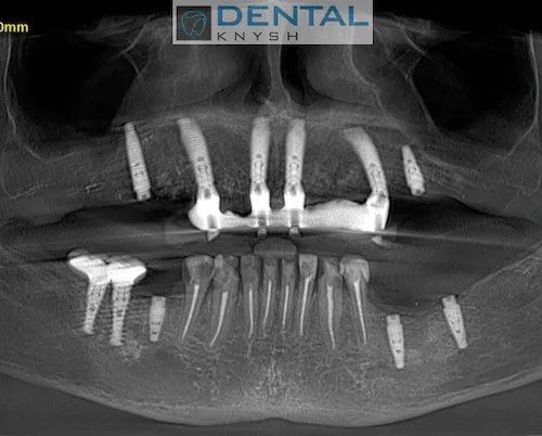 Імплантація зубів в DentalKnysh 2026-08