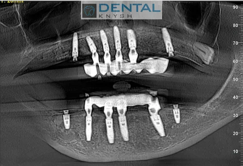Імплантація зубів в DentalKnysh 2026-09
