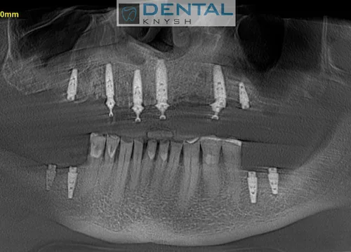 Імплантація зубів в DentalKnysh 2026-09-01