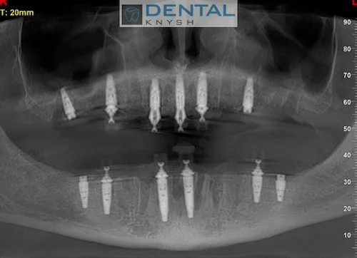 Імплантація зубів в DentalKnysh 2026-09-04