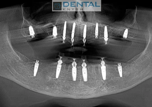 Імплантація зубів в DentalKnysh 2026-09-12