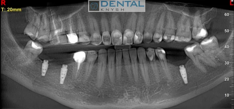 Імплантація зубів в DentalKnysh 2026-09-20