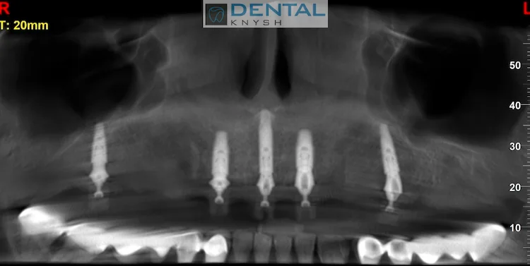 Імплантація зубів в DentalKnysh 2026-09-16