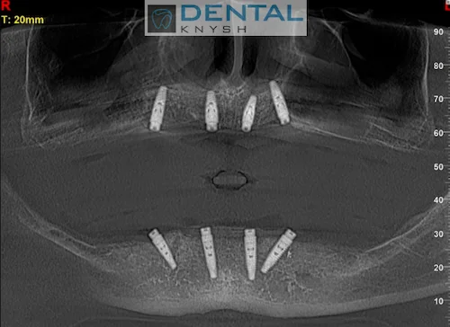 Імплантація зубів в DentalKnysh 2026-09-08